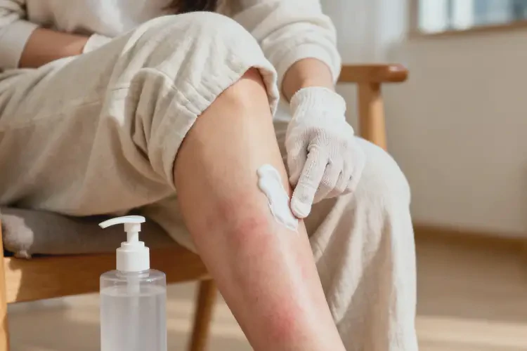 哺乳期媽媽小腿上容易長濕疹能夠徹底治愈嗎(圖3)