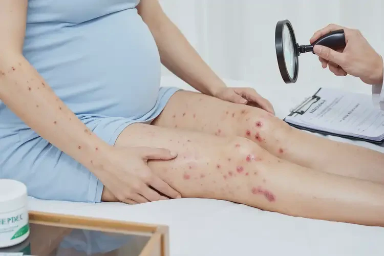 孕婦大腿上容易長濕疹可以徹底自愈嗎(圖4)