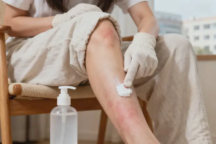 哺乳期媽媽小腿上容易長濕疹能夠徹底治愈嗎(圖2)