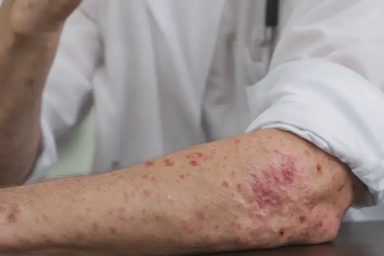 男性手臂出現(xiàn)濕疹能徹底自愈嗎(圖4)