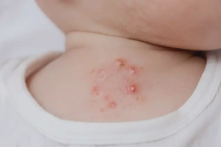 寶寶脖子經(jīng)常起濕疹不管它會自己好嗎(圖4)