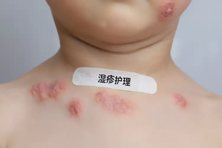 小孩脖子容易起湿疹不管它会自己好吗(图4)