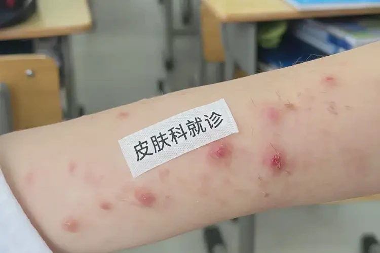小學(xué)生手臂有濕疹可以徹底自愈嗎(圖4)