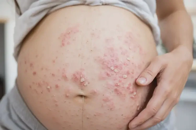 哺乳期媽媽肚子上容易起濕疹可不可以徹底自愈(圖4)