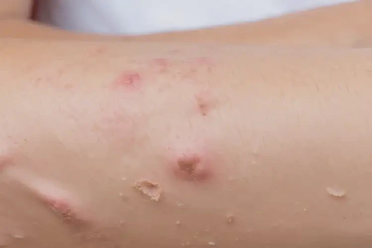 大學(xué)生手臂上偶爾起濕疹能夠徹底治愈嗎(圖4)