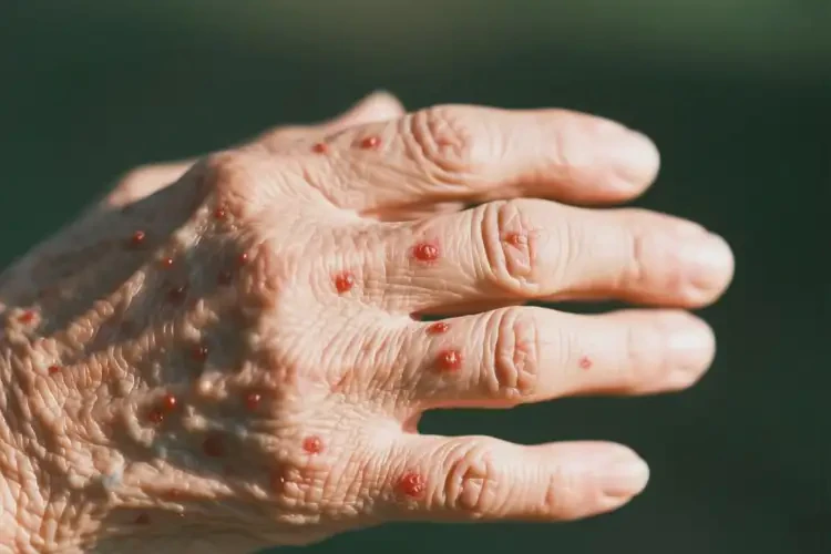 老年人手臂上經(jīng)常長濕疹不管它會(huì)自己痊愈嗎(圖3)