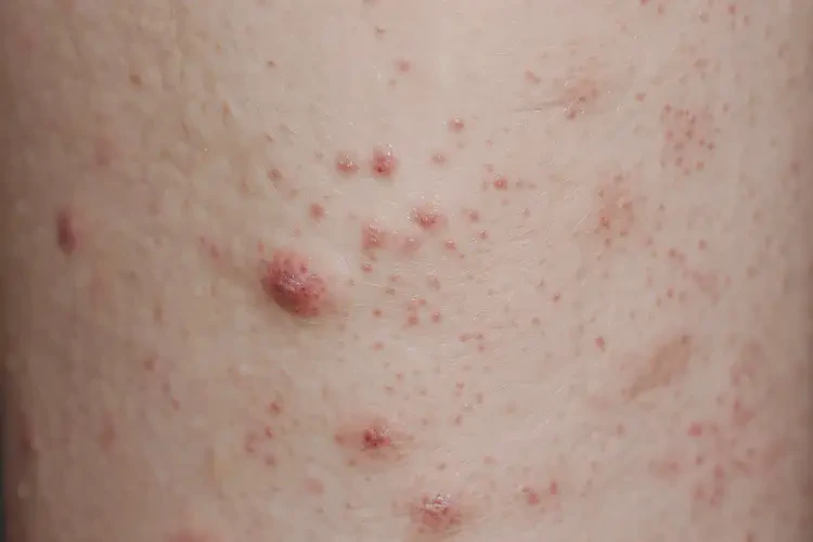 產(chǎn)婦小腿經(jīng)常起濕疹能徹底自愈嗎(圖4)