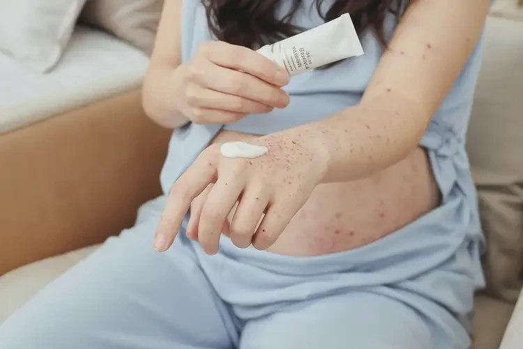 孕婦手上出濕疹可不可以徹底自愈(圖3)