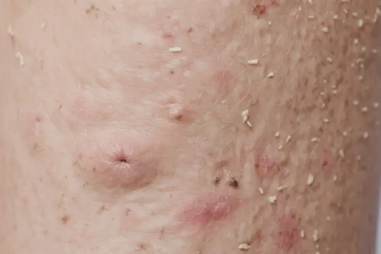 小孩全身長濕疹能靠自己自愈嗎(圖3)