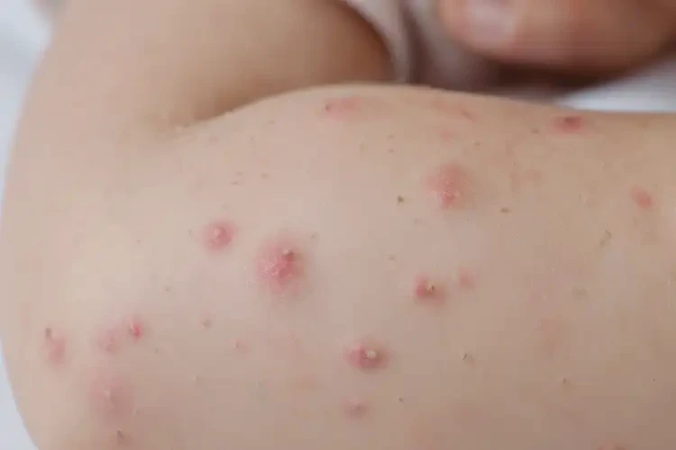 少兒全身容易起濕疹不管它會(huì)自己好嗎(圖4)