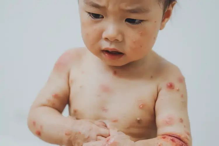 孩子全身起湿疹能彻底自愈吗(图4)