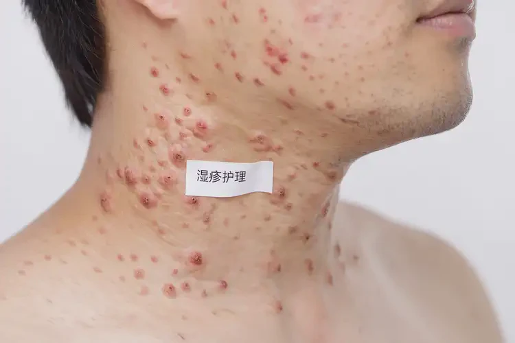 青年人脖子上長濕疹能不能徹底自愈(圖4)