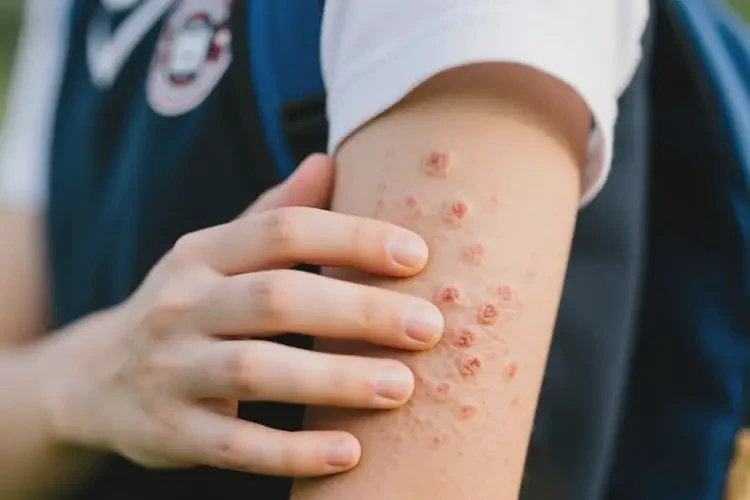 中學(xué)生手臂上起濕疹能徹底自愈嗎(圖1)