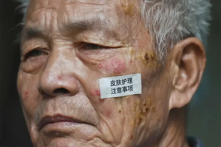 高齡老人屁股上偶爾長濕疹可不可以徹底自愈(圖4)