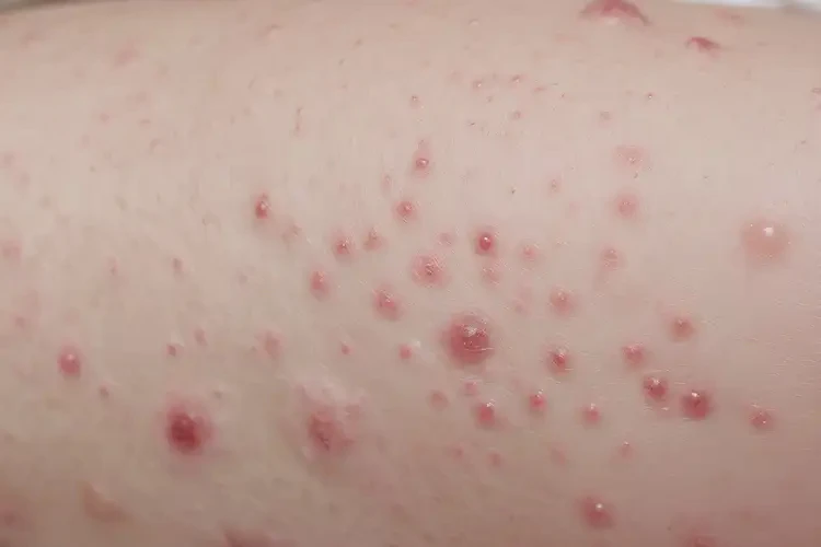 嬰幼兒全身有濕疹可不可以徹底自愈(圖4)