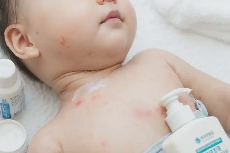小兒脖子上有濕疹可不可以徹底自愈(圖3)