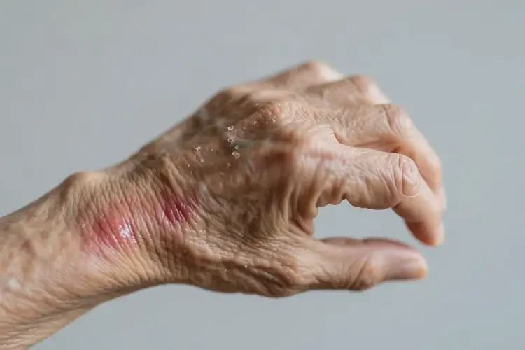 老人身上偶爾長濕疹能靠自己自愈嗎(圖2)