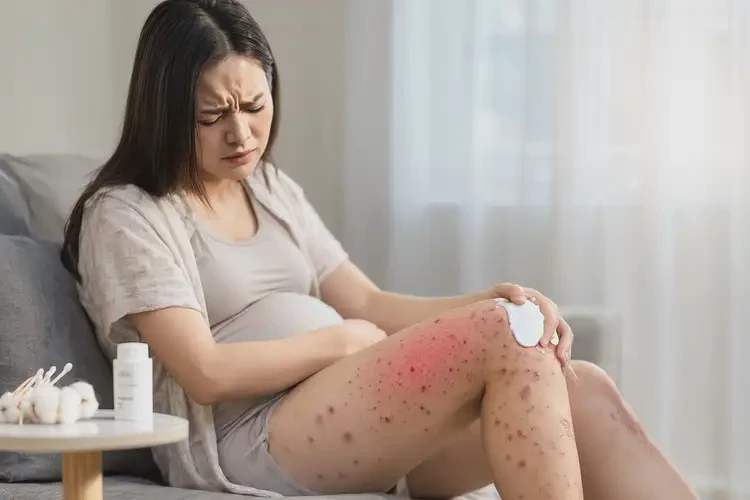 孕婦大腿容易起濕疹可以徹底自愈嗎(圖3)