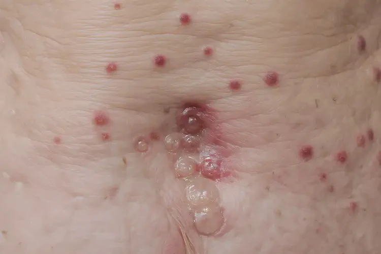 老年人肛周起濕疹不管它會自己好嗎(圖4)