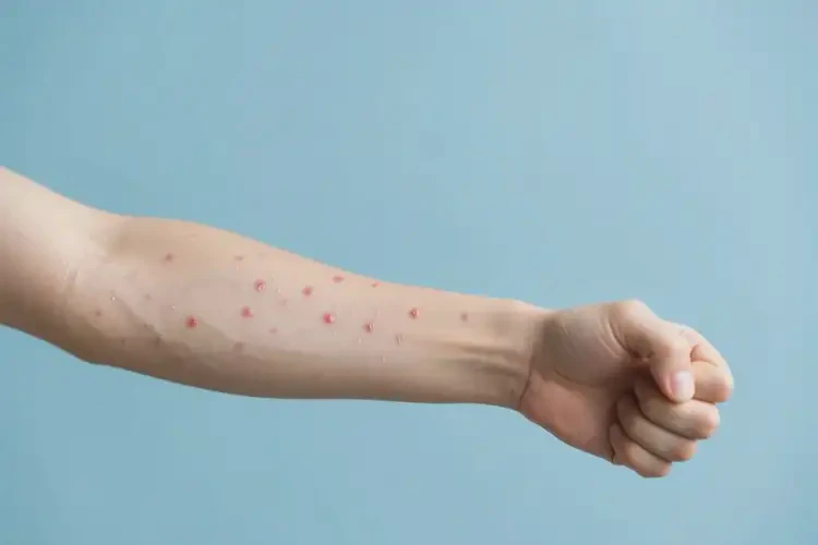 青年人手臂偶尔长湿疹能不能彻底自愈(图1)