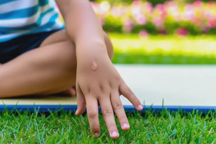 孩子手上經(jīng)常長(zhǎng)濕疹不管它會(huì)自己自愈嗎(圖3)