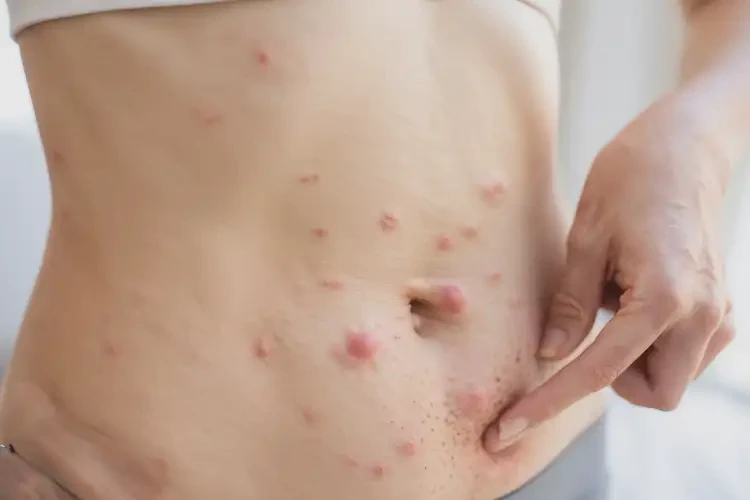 哺乳期媽媽肚子起濕疹不管它會(huì)自己好嗎(圖4)