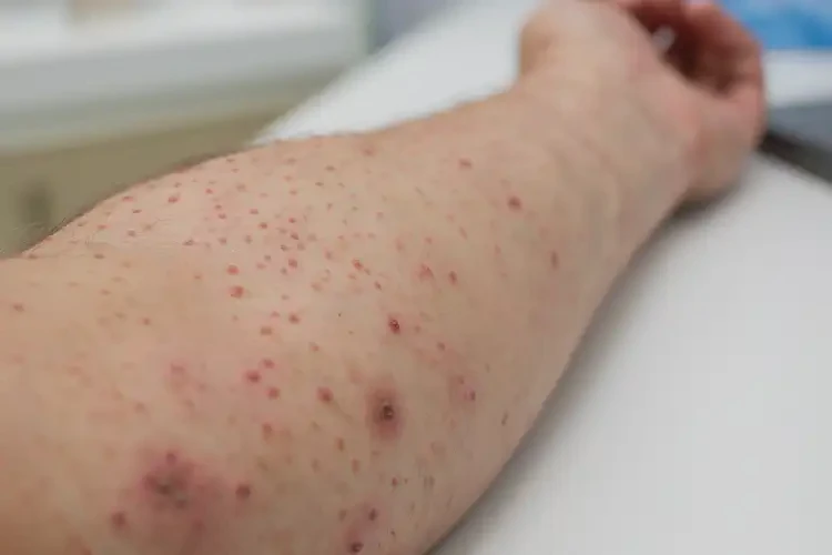 青年人四肢容易起濕疹能不能徹底自愈(圖4)