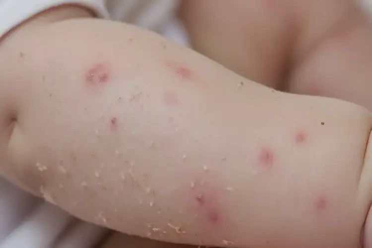 嬰兒手臂容易長濕疹可以徹底自愈嗎(圖3)
