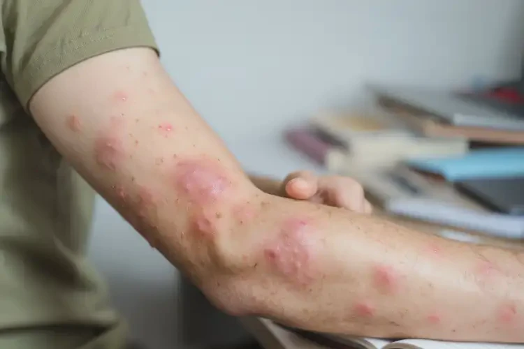 大學(xué)生手臂上容易長濕疹不管它會(huì)自己自愈嗎(圖4)