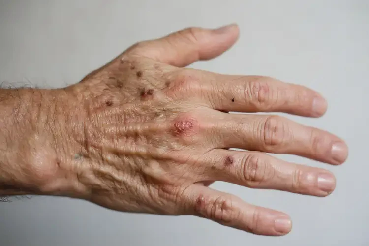 老人手上偶爾長(zhǎng)濕疹不管它會(huì)自己好嗎(圖3)