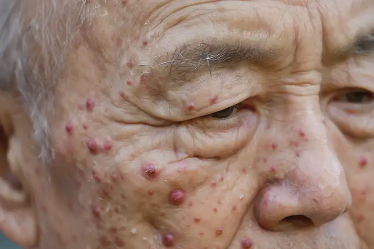 老年人全身起濕疹不管它會(huì)自己好嗎(圖4)