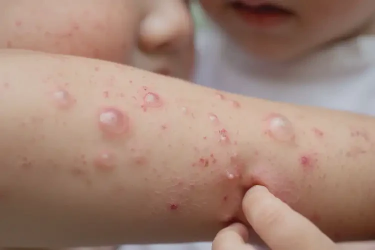 小儿全身偶尔长湿疹能够彻底治愈吗(图4)