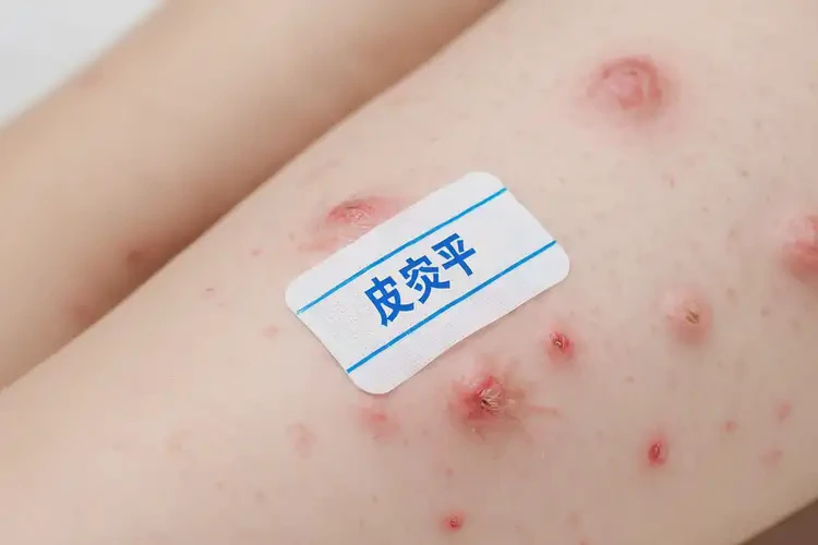 女人手臂起濕疹能徹底自愈嗎(圖4)