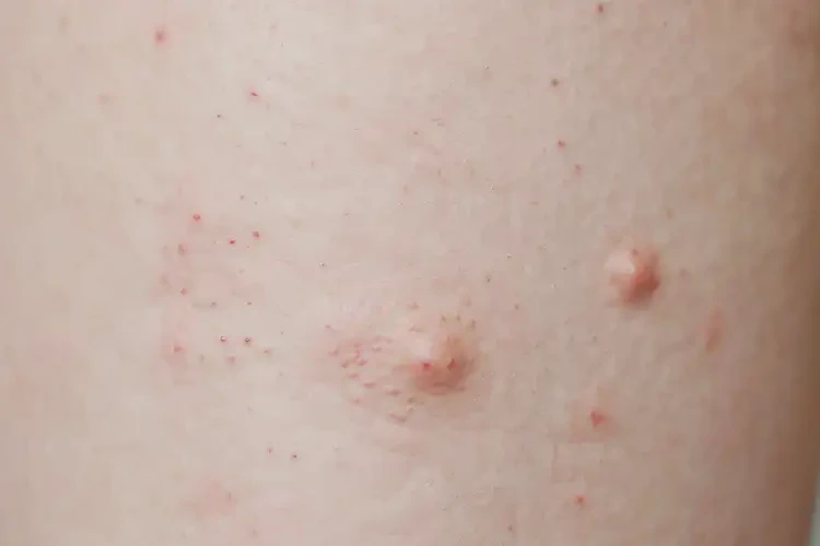 孩子大腿上偶尔长湿疹不管它会自己好吗(图3)