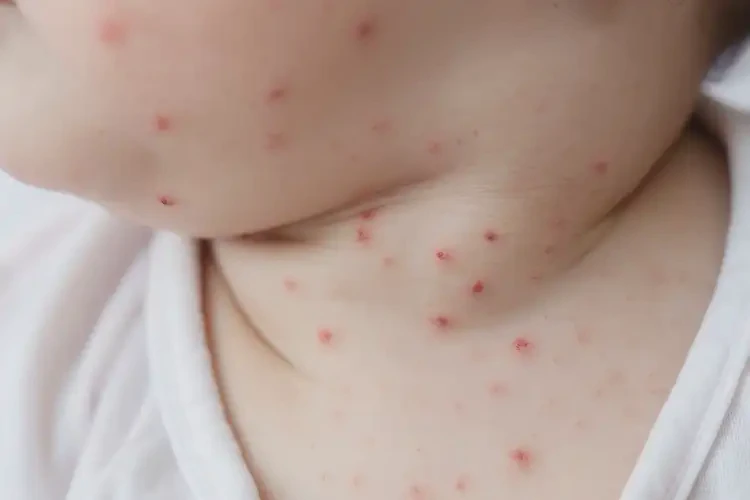 小兒脖子上容易起濕疹能靠自己自愈嗎(圖4)
