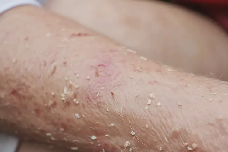 老人手臂出現(xiàn)濕疹能徹底自愈嗎(圖4)