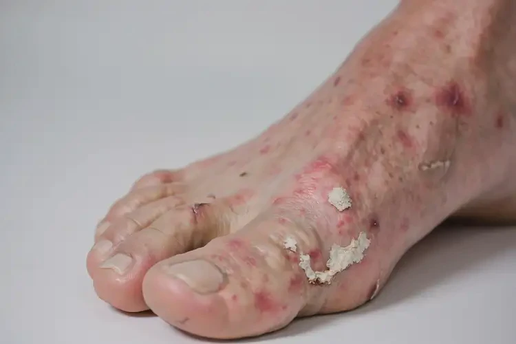 男人脚上有湿疹不管它会自己痊愈吗(图4)