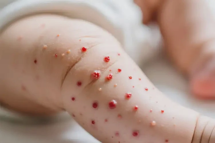 嬰幼兒大腿上出濕疹不管它會(huì)自己痊愈嗎(圖2)