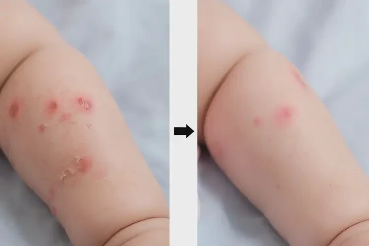 新生兒身上起濕疹能夠徹底治愈嗎(圖3)