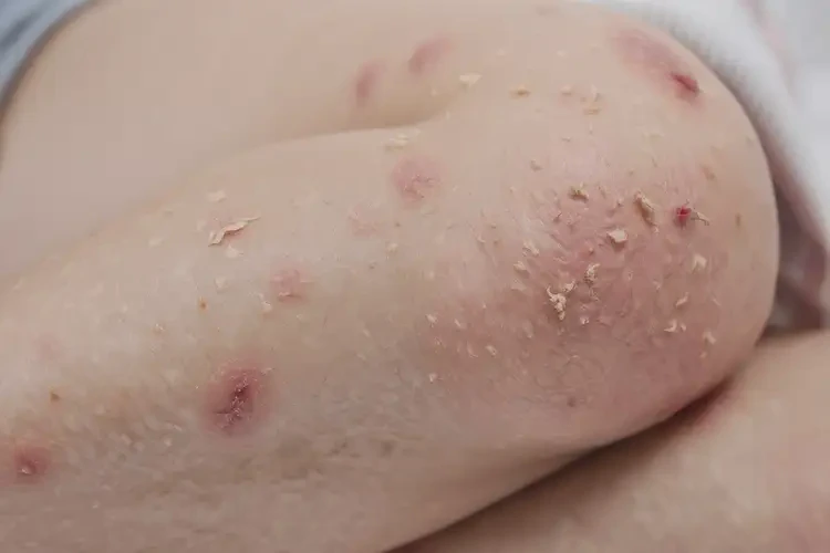 兒童大腿上經(jīng)常起濕疹能靠自己自愈嗎(圖4)