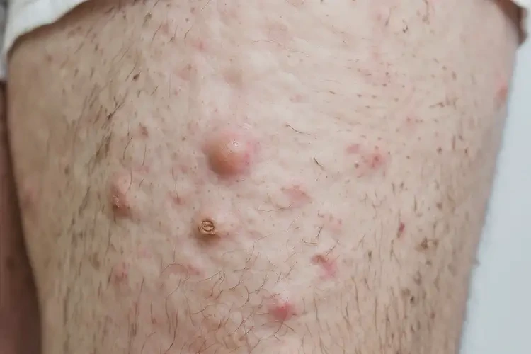 男性大腿上出濕疹能靠自己自愈嗎(圖4)