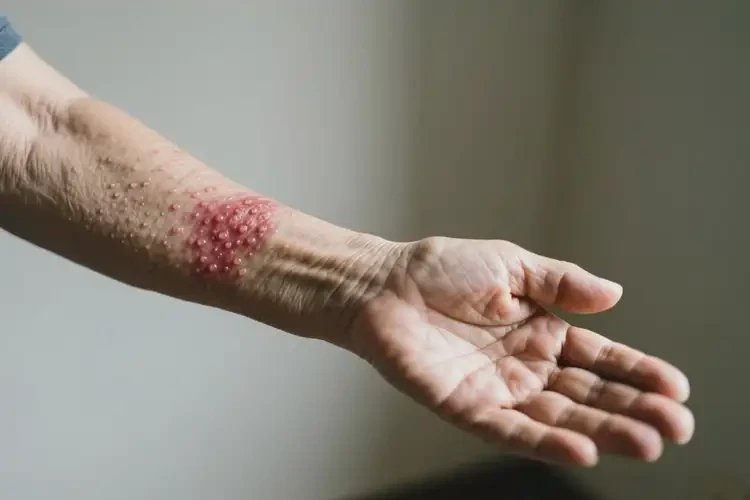 老年人手臂上出濕疹不管它會(huì)自己好嗎(圖1)