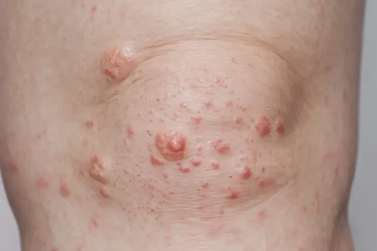 女性小腿長濕疹不管它會(huì)自己自愈嗎(圖4)