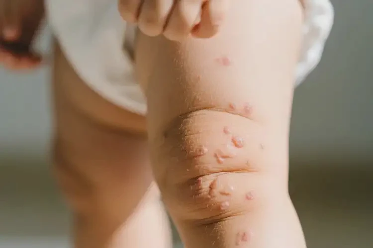 幼兒大腿上經(jīng)常起濕疹能靠自己自愈嗎(圖4)