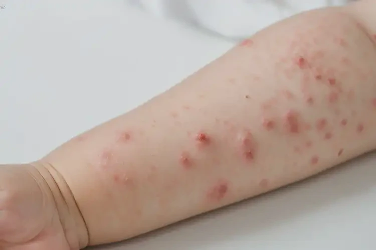 小孩手臂上出現(xiàn)濕疹能夠徹底治愈嗎(圖4)