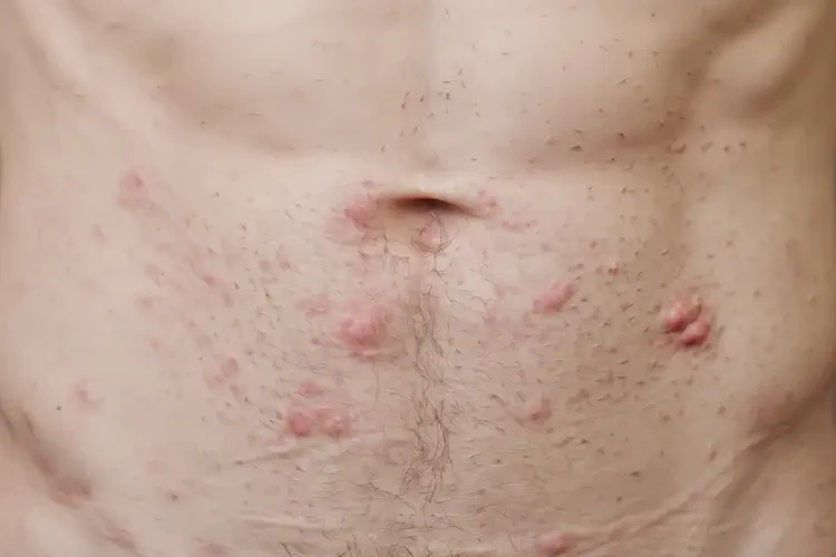 青年人肚子起濕疹能徹底自愈嗎(圖4)