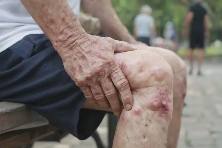 老年人小腿起濕疹不管它會(huì)自己好嗎(圖4)