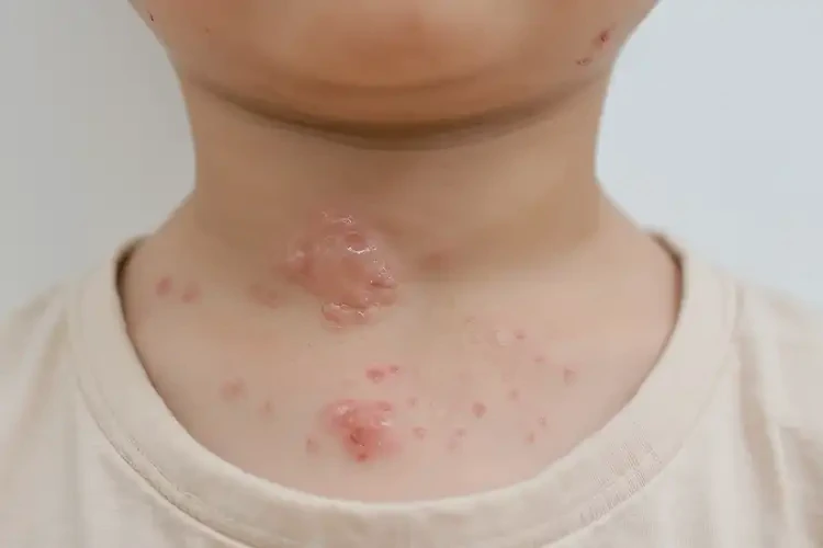 小學(xué)生脖子上起濕疹不管它會(huì)自己自愈嗎(圖2)
