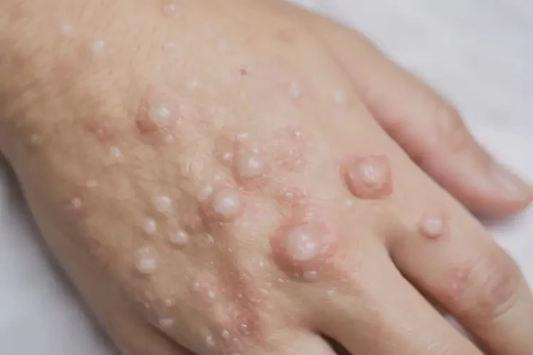 中學(xué)生四肢偶爾起濕疹不管它會自己痊愈嗎(圖2)