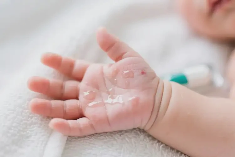 新生兒手上容易起濕疹不管它會自己痊愈嗎(圖3)